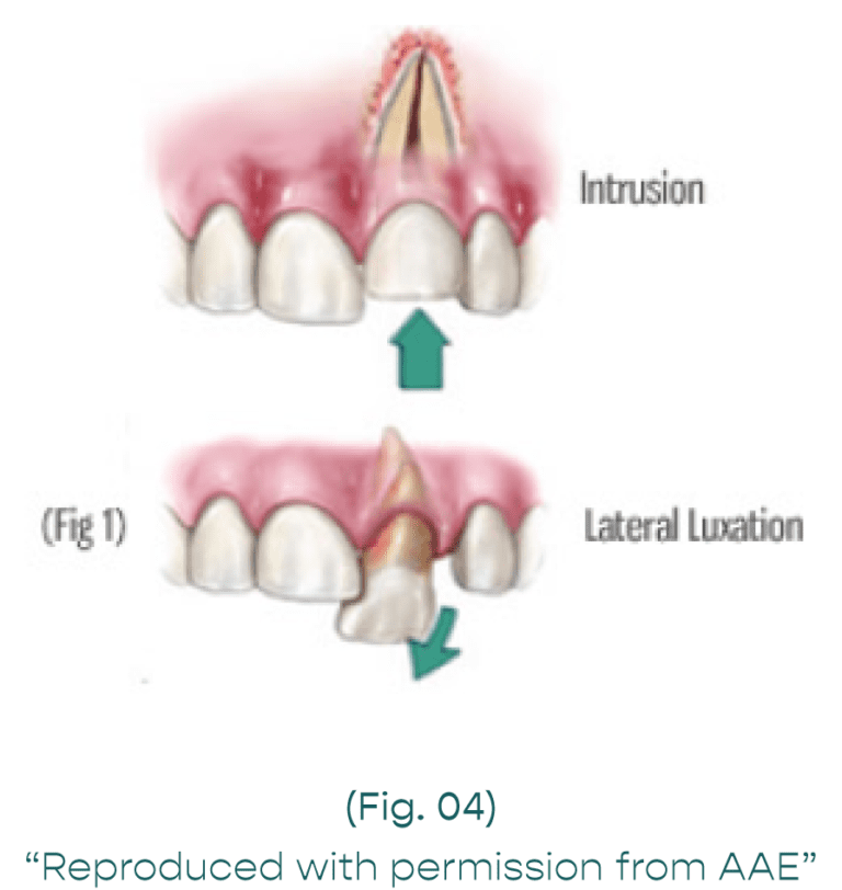 tooth luxation